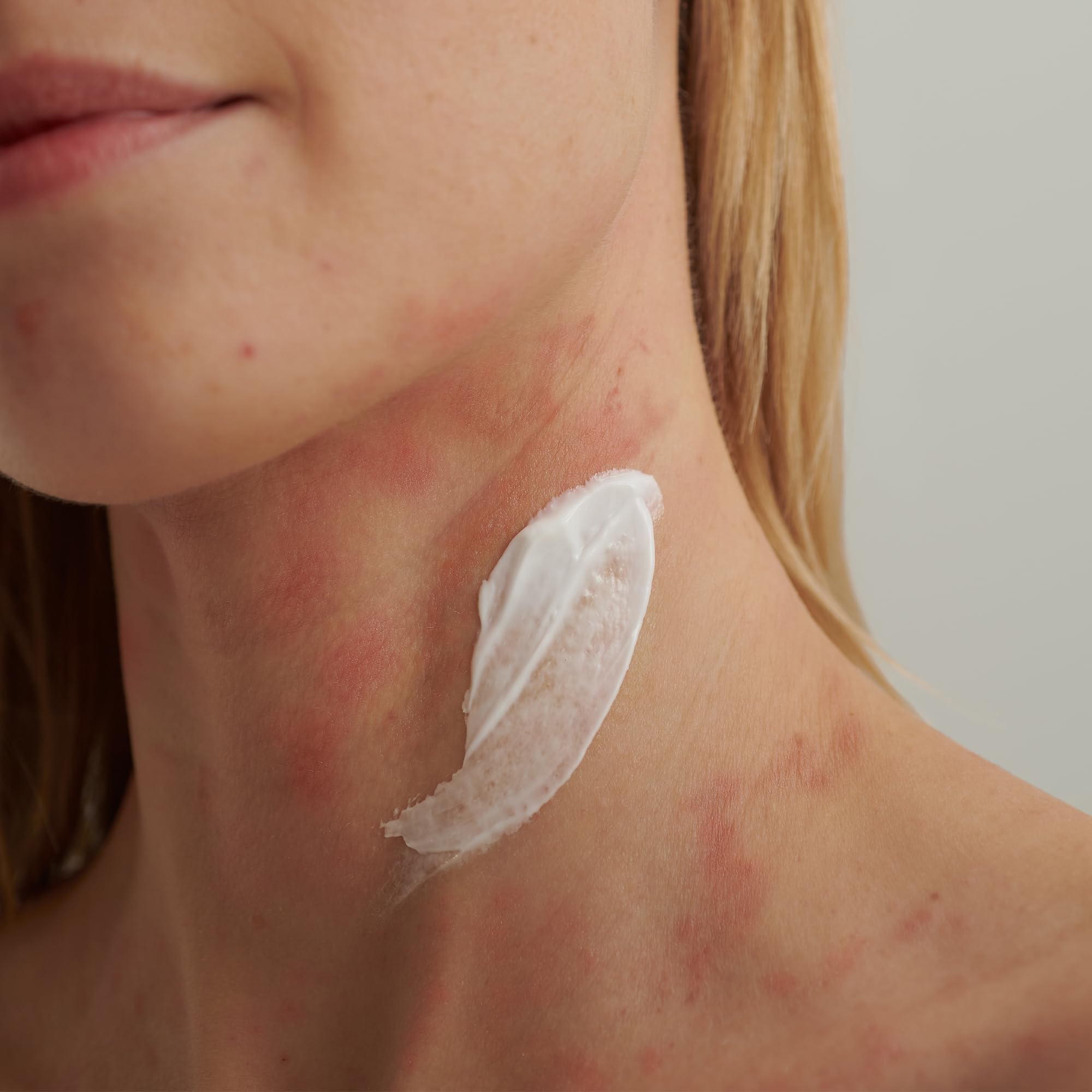 dado-sens-extroderm-intensivcreme-50-ml-bei-neurodermitis-psoriasis image 5