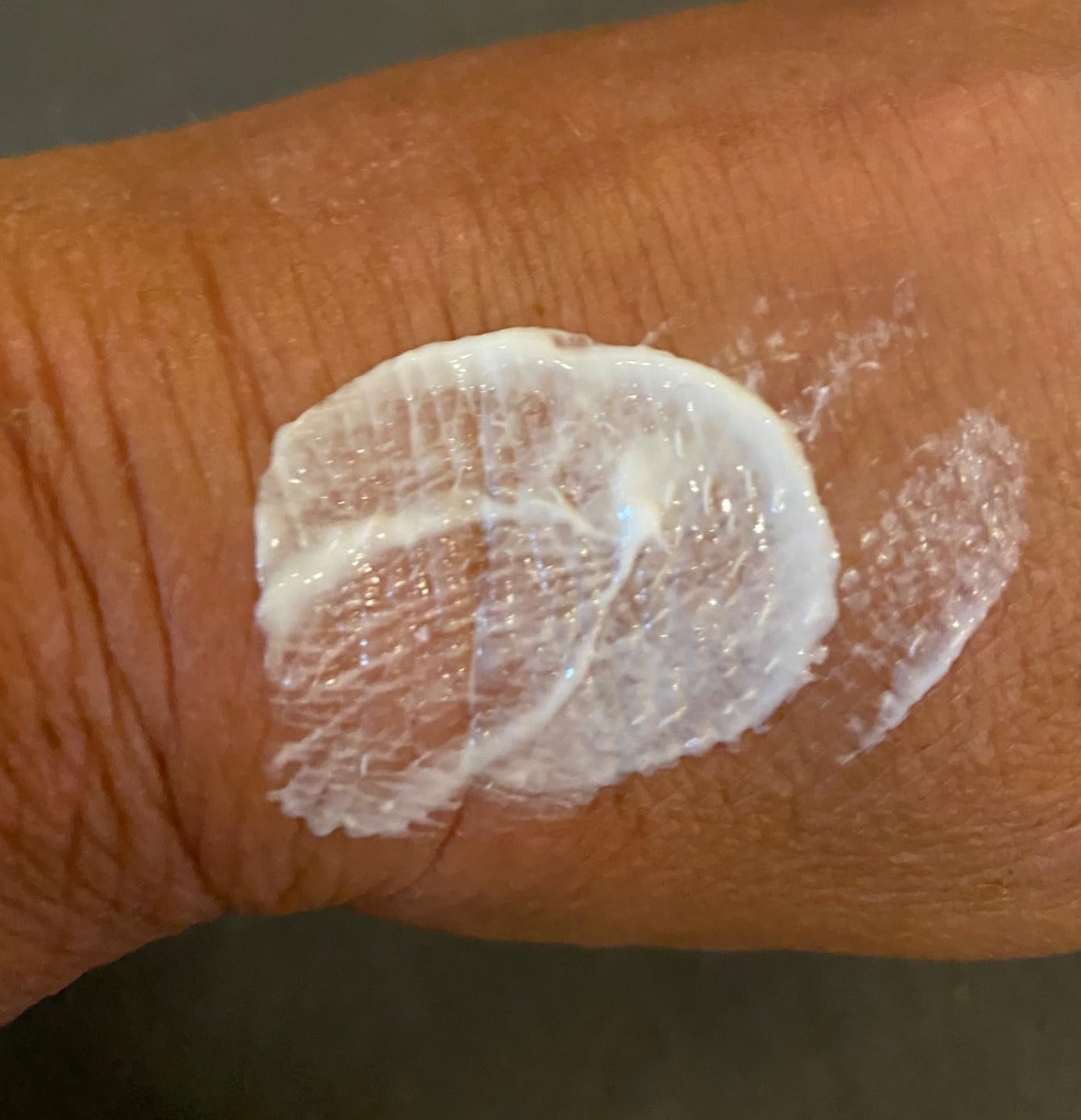 Endlich Linderung bei Rosacea